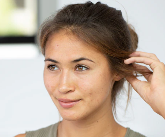 5 Reasons Your Acne Won’t Go Away